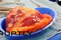 Sự thật kinh ngạc về quả tim của người nghiện ma túy