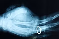 Nối ngón tay thành công cho một bệnh nhân ở Nghệ An