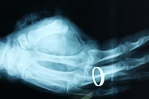 Nối ngón tay thành công cho một bệnh nhân ở Nghệ An