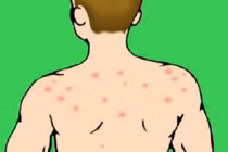 6 bước thổi bay mụn trứng cá ở lưng