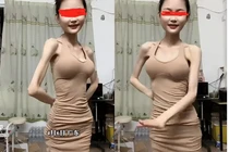 Hoảng hốt với cô gái thân hình mỏng tang vì giảm cân quá đà