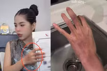 Hằng Du Mục lên livestream với gương mặt bầm tím, netizen lo lắng