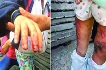 Bé tiểu học bị mẹ kế bạo hành gây phẫn nộ