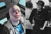 Bỏng 95% cơ thể, chàng trai từng coi mình là quái vật giờ ra sao?