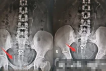 Tưởng sỏi thận, ai ngờ cơ thể giấu thứ ghê rợn này 20 năm