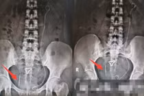 Tưởng sỏi thận, ai ngờ cơ thể giấu thứ ghê rợn này 20 năm