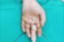 Nhẫn quá chật, cô gái làm điều này khiến ngón tay chỉ còn...xương trắng