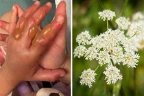 Hè đi chơi vô tình chạm vào cây này, bé gái bỏng cấp 3