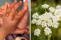 Hè đi chơi vô tình chạm vào cây này, bé gái bỏng cấp 3