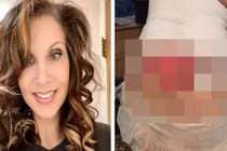 Nâng ngực cứu vãn hôn nhân, người phụ nữ gặp họa lớn