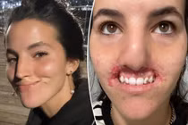 Người mẫu mất toàn bộ môi trên vì bị chó dữ tấn công