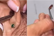 Đau âm ỉ trong tai, sốc nặng phát hiện “quái thú” ẩn náu