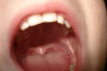 Thấy đốm trên lưỡi tưởng bệnh tình dục, ai ngờ ung thư