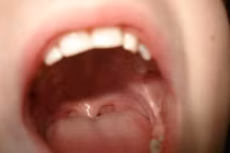 Thấy đốm trên lưỡi tưởng bệnh tình dục, ai ngờ ung thư