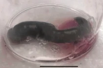 Bé gái chảy máu cam liên tục, hóa ra do “quái vật” hút máu