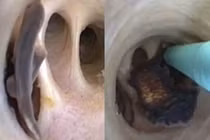 Ăn cá kiểu này, người đàn ông khiến bác sĩ run rẩy