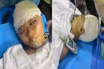 Thầy giáo đánh nữ sinh 9 tuổi chấn thương sọ não gây phẫn nộ