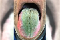 Ghê rợn lưỡi mọc lông xanh vì uống thuốc kháng sinh quá liều 