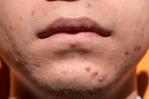 Mọc mụn vị trí này trên mặt, bệnh tật đầy người 