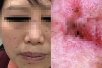 Đi khám da liễu, người phụ nữ phát hiện ung thư bởi điều này 