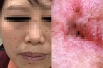 Đi khám da liễu, người phụ nữ phát hiện ung thư bởi điều này 