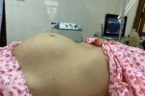 Bụng to như mang thai, đi khám mới biết đối diện tử thần