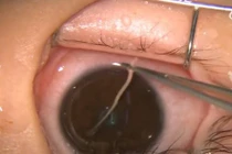 Hay dụi mắt, bé gái không ngờ đã nuôi cả ổ giun bên trong 