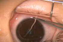 Hay dụi mắt, bé gái không ngờ đã nuôi cả ổ giun bên trong 