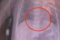Bé gái co giật dữ dội, hóa ra kim thêu đâm thẳng vào tim