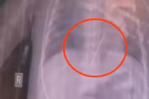 Bé gái co giật dữ dội, hóa ra kim thêu đâm thẳng vào tim