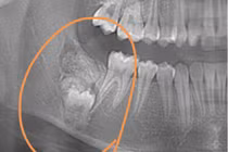 Đi chỉnh nha, bé gái được yêu cầu phẫu thuật ngay vì bệnh hiểm