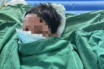 Uống thuốc cảm khi sốt, bé trai bị lột da toàn thân vì...