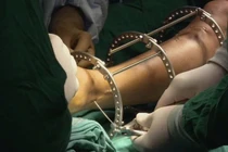 Ham kéo dài chân, cô gái 19 tuổi không thể đi lại được