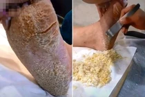  Chuyên gia làm đẹp hết hồn với bàn chân như “người đất” của khách hàng