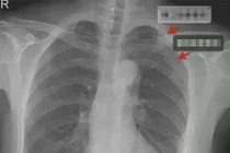 Bị nam đồng nghiệp ôm quá mạnh, cô gái gãy 3 xương sườn