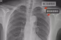 Bị nam đồng nghiệp ôm quá mạnh, cô gái gãy 3 xương sườn