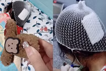 Dùng kẹp tóc càng cua, bé gái phải khâu 3 mũi trên đầu vì...