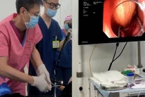 Bị táo bón, chàng trai thông ruột bằng cách kinh dị...nhập viện gấp