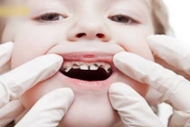 Bé 3 tuổi sâu cả hàm răng vì thói quen tưởng tốt này