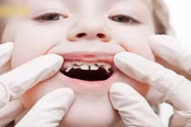 Bé 3 tuổi sâu cả hàm răng vì thói quen tưởng tốt này