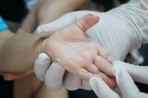 Bé trai tử vong sau 4 ngày có biểu hiện bệnh tay chân miệng