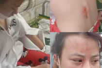 Hà Tĩnh: Khởi tố gã hàng xóm đánh nữ sinh lớp 10 chấn động não