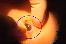 Ôm ấp chó cưng, bé trai bị ký sinh trùng làm tổ trong mắt 