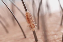 Bị chấy hút máu ký sinh, bé gái cạn máu rồi qua đời 