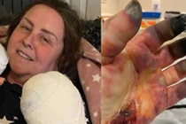 Nhiễm bệnh lạ, người phụ nữ có bàn tay phù thủy đáng sợ