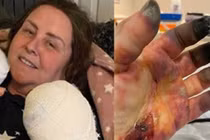 Nhiễm bệnh lạ, người phụ nữ có bàn tay phù thủy đáng sợ