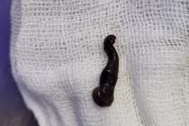 Phát hiện đỉa sống nhiều tháng trong khe mũi 