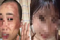 Không chịu sinh con thứ 2, vợ bị chồng tạt axit 