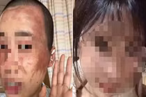 Không chịu sinh con thứ 2, vợ bị chồng tạt axit 