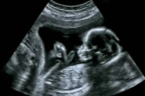 Siêu âm thấy con trai lè lưỡi dễ thương, ai ngờ bi kịch